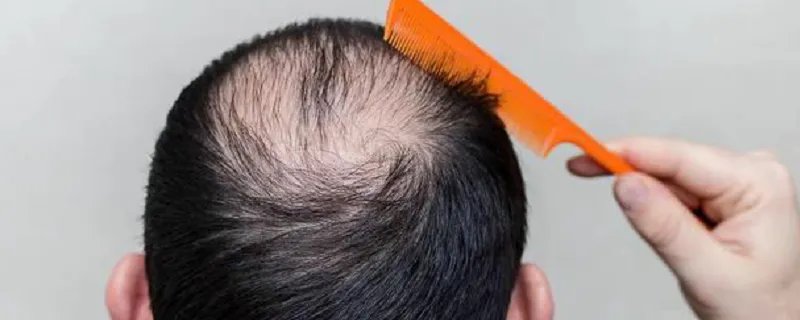 梦到秃顶意味着什么 梦到秃顶有什么征兆