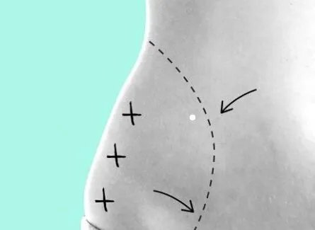 吸脂和抽脂的区别