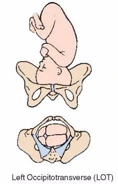 LOA常见的胎位图有哪些?