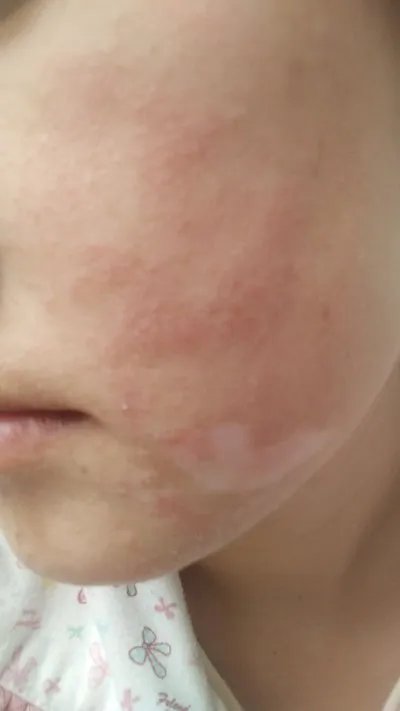 湿疹和皮炎一样吗？