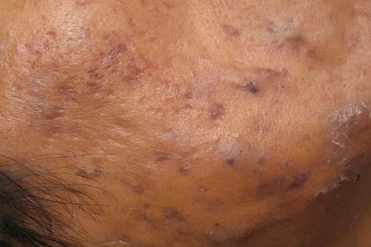 深痘坑和浅痘坑图片