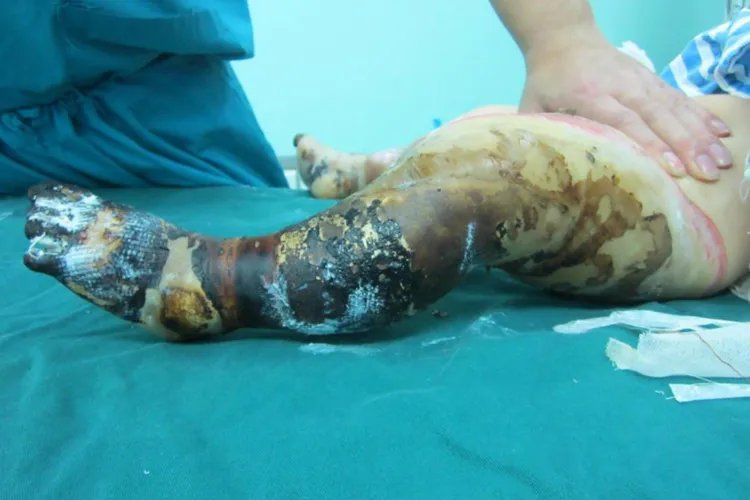 被火烧伤的小孩图片