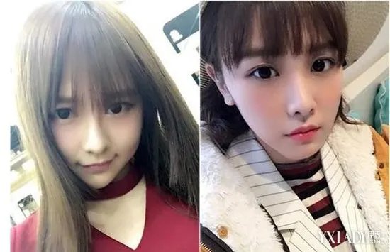 唐安琪脸部植皮恐永留伤痕回顾具体烧伤经历