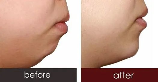 做垫下巴价格是多少