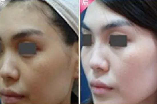 美白针10针效果图