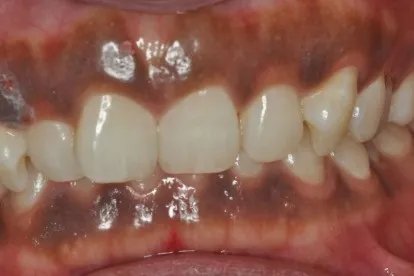 牙床发黑紫是怎么回事图片