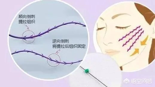 面部提升埋线是怎么回事？