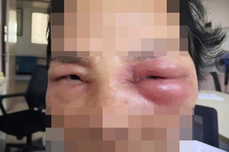 急性蜂窝组织炎的症状图片