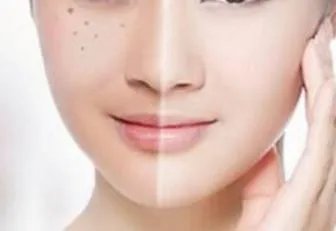 激光祛斑效果怎么样