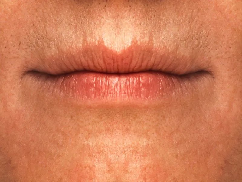 嘴角烂了怎么办