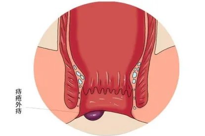 产后痔疮外痔肉球图片