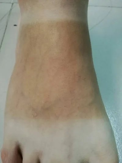 湿疹和皮炎一样吗？