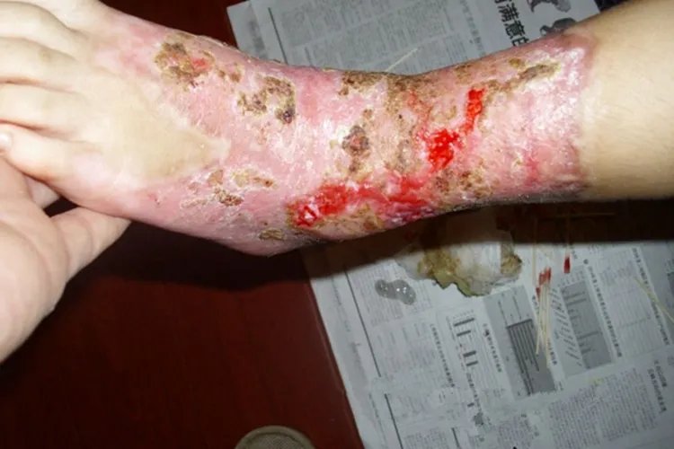 被火烧伤的小孩图片