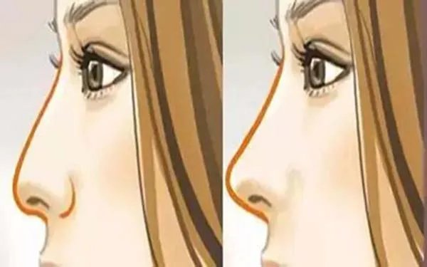 北京肋软骨隆鼻口碑好的医院是哪家