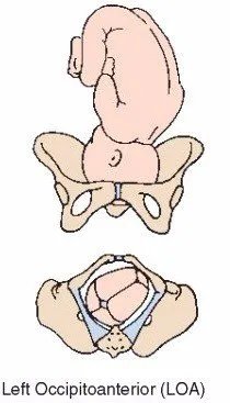 LOA常见的胎位图有哪些?