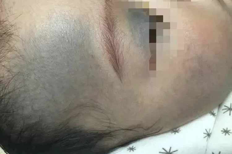 胎记有几种颜色的图片