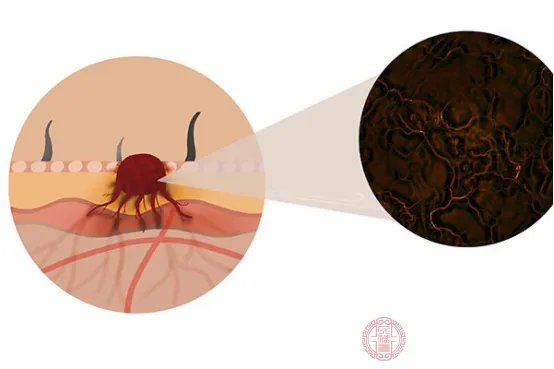 癌症除了药物治疗之外还有哪些治疗方法