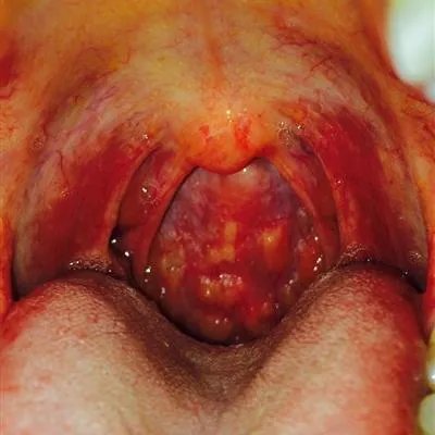 咳嗽破音是怎么回事?