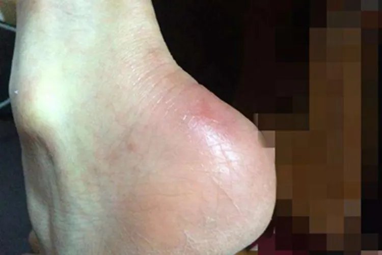 浸渍足脚后跟症状图片