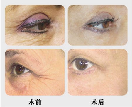 去鱼尾纹多少钱？