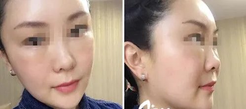 苏州做面部脂肪填充哪家医院好？