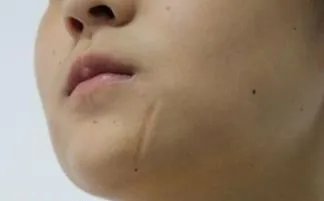 去凹陷疤痕多少钱