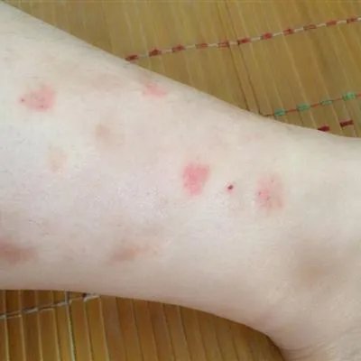 什么原因得紫癜