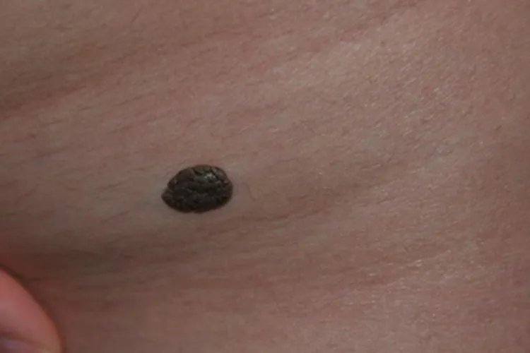 浅表播散型黑色素瘤颈部黑痣图片