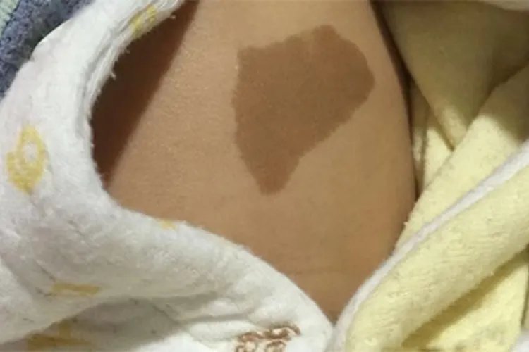 胎记有几种颜色的图片