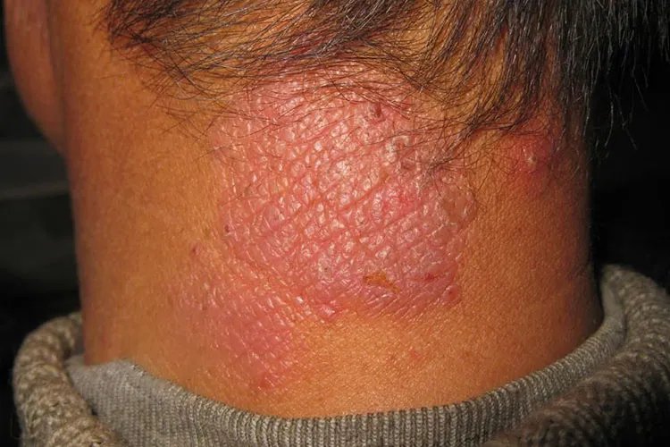 神经性皮炎图片