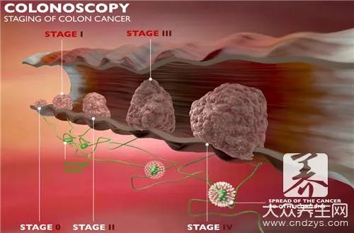 低分化鳞癌一般生存期