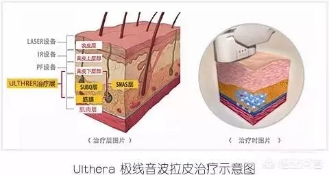 超声刀危害有哪些？