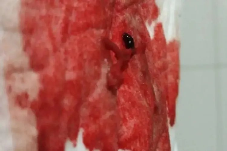 宫颈癌出血跟月经区别图片