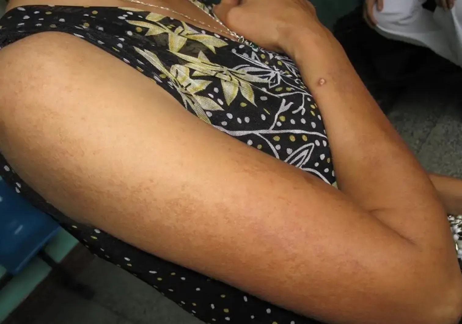 家族性进行性色素沉着皮肤发黑图片