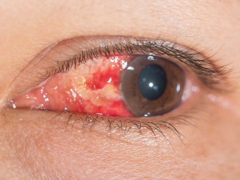 眼白突然出现一块红色是什么原因