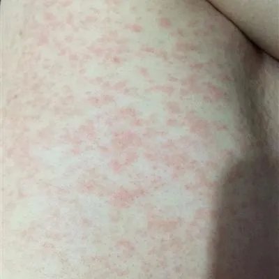 什么原因得紫癜