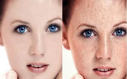 激光祛斑的副作用