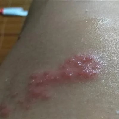 缠身龙是什么症状图片