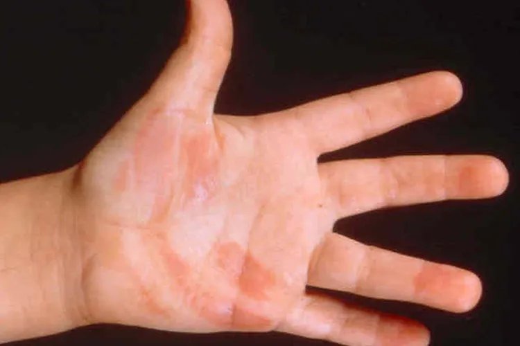 被火烧伤的小孩图片