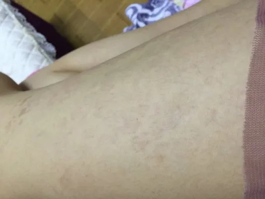 湿疹和皮炎一样吗？