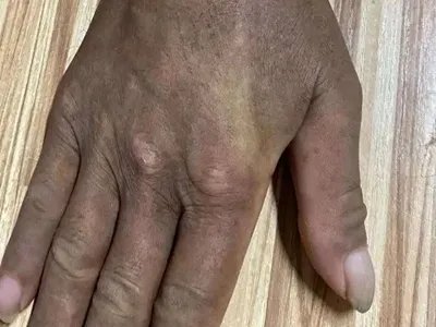 家族性进行性色素沉着皮肤发黑图片