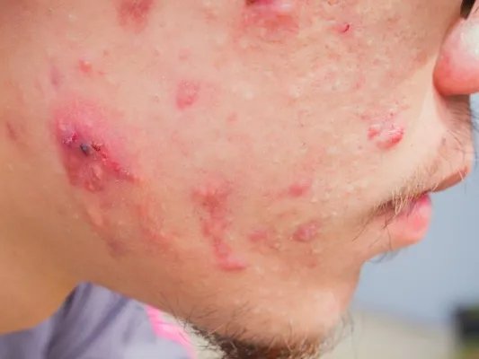 结节性痤疮的治疗方法