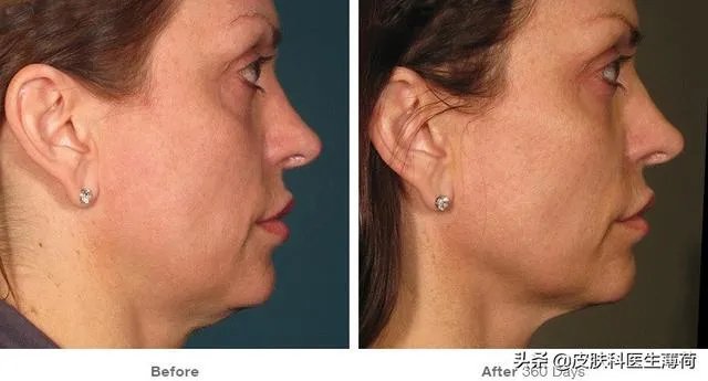 超声刀危害有哪些？