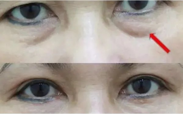 去眼袋最有效的方法