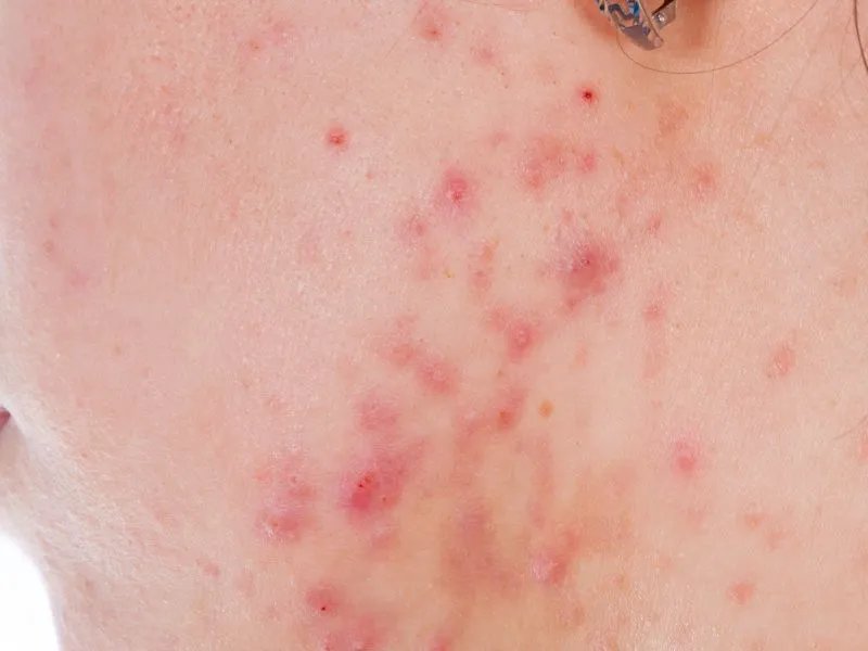 如何去除痤疮疤痕