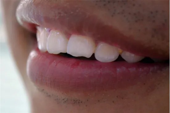 烤瓷牙的危害有哪些