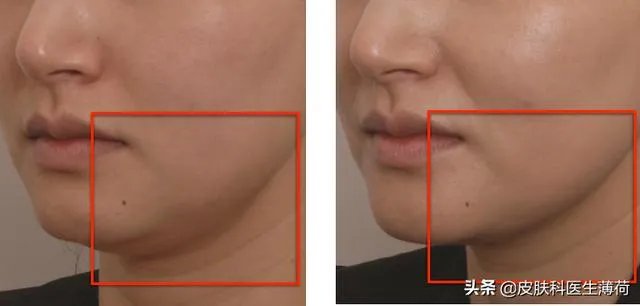 超声刀危害有哪些？