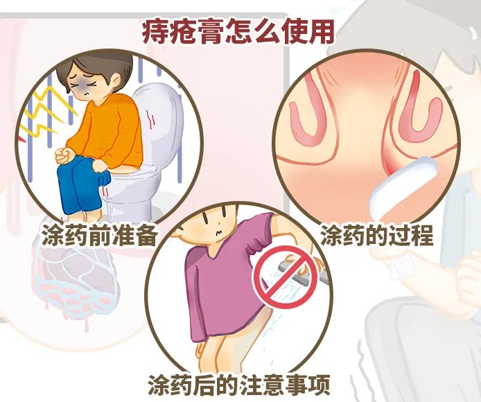 痔疮膏怎么使用