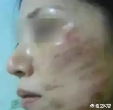 超声刀危害有哪些？