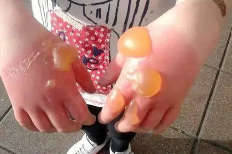 被火烧伤的小孩图片